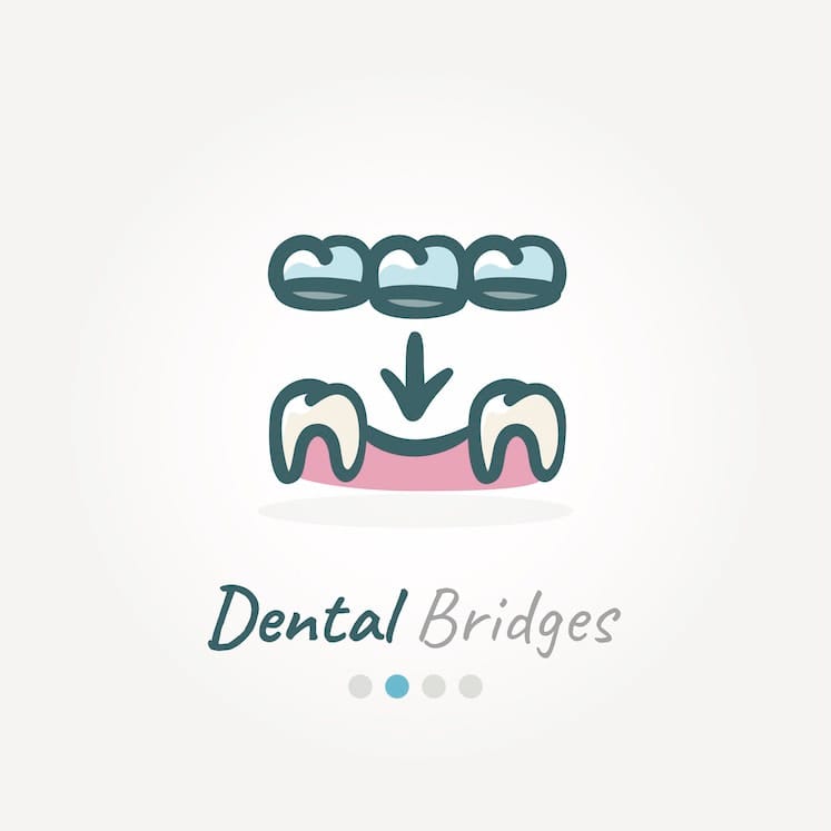 Dental bridge for front teeth