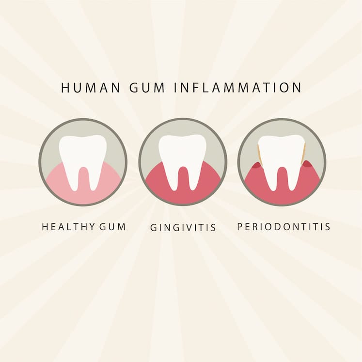 Human gum inflammation stages: healthy, gingivitis and periodontitis